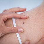 Warning signs of melanoma and how to tell if a spot is cancerous